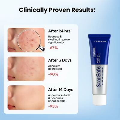Japan's #1 Acne Solution | ScarSafe Acne Cream | Heal Acne, Redness & Scars in Just 3 Days