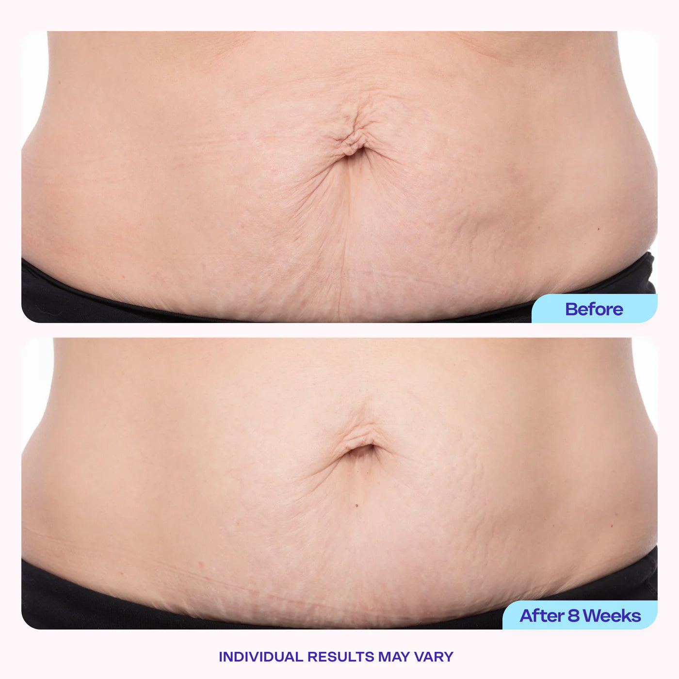 Belly Firming & Stretch Mark Cream | Noticeable Results in Just 2 Weeks.