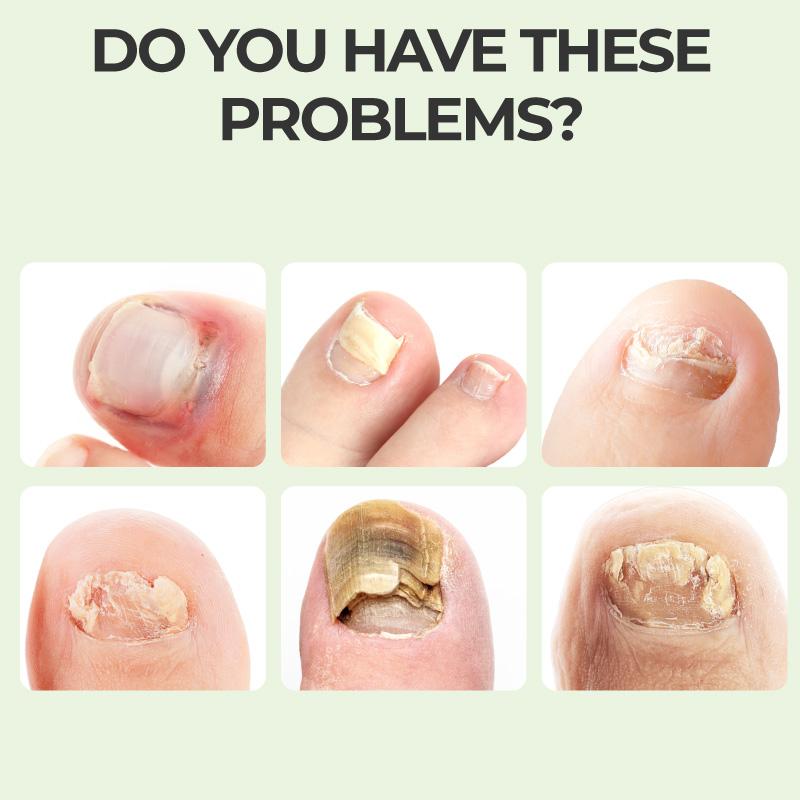 Nail Repair Magic Drops Multi Purpose Nail Repair Lotion for Discolored and Damaged Nails